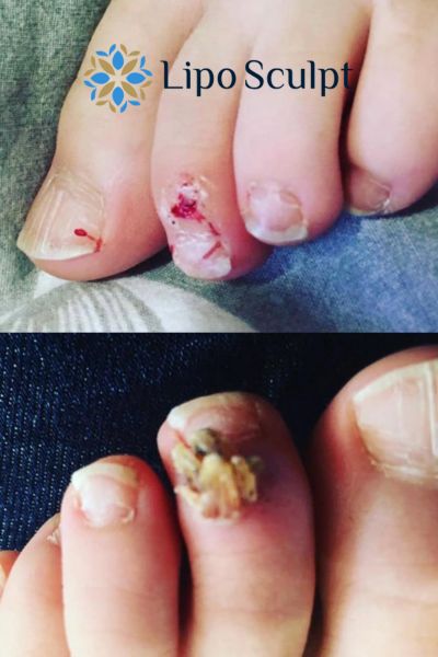 Wart removal customer results from Lipo Sculpt Enfield